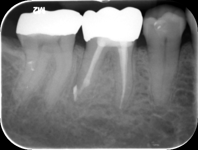 Wurzelentzündung Zahn Ziehen